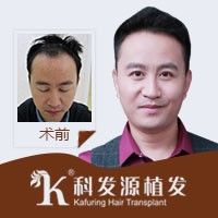 国内哪家种植头发的医院效果好 图片 5