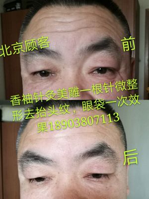 香袖针灸美雕一根针微整形 NJ photo 10