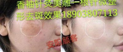 香袖针灸美雕一根针微整形 NJ photo 5