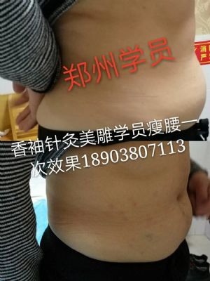 香袖针灸美雕一根针微整形 NJ photo 6