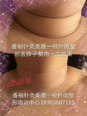 香袖针灸美雕一根针微整形 NJ photo 7