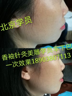 香袖针灸美雕一根针微整形 NJ photo 1