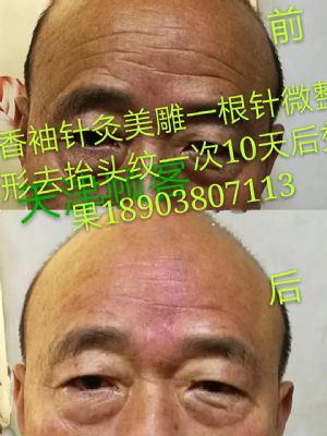 香袖针灸美雕一根针微整形 NJ photo 8