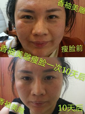 香袖针灸美雕一根针微整形 NJ photo 4