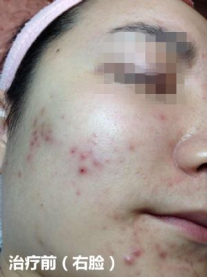 纽约法拉盛中药治痘,1天见效,20天包好 图片 3