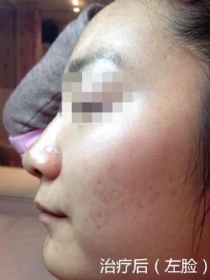 纽约法拉盛中药治痘,1天见效,20天包好 图片 7