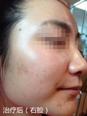 纽约法拉盛中药治痘,1天见效,20天包好 图片 4