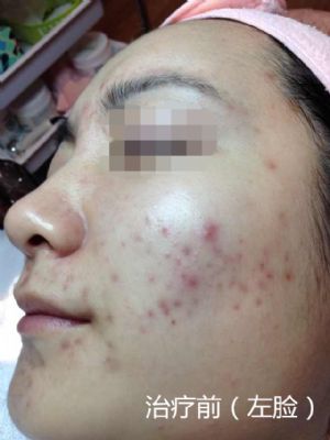 纽约法拉盛中药治痘,1天见效,20天包好 图片 5