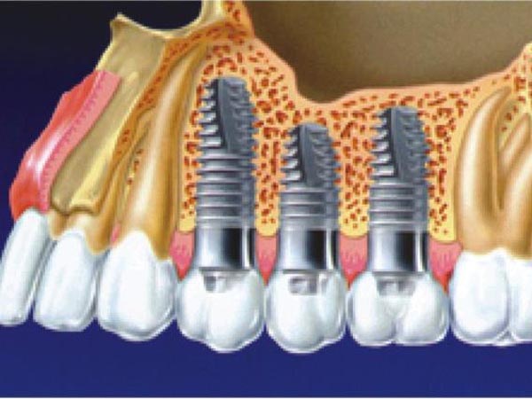 凌甡牙醫博士─人工植牙專科 图片 1