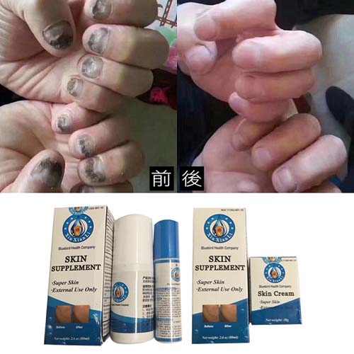 灰指甲‧手足癬 图片 2