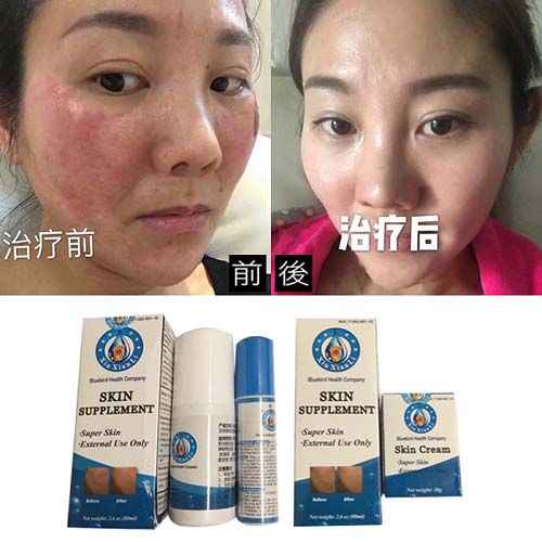 灰指甲‧手足癬 图片 3