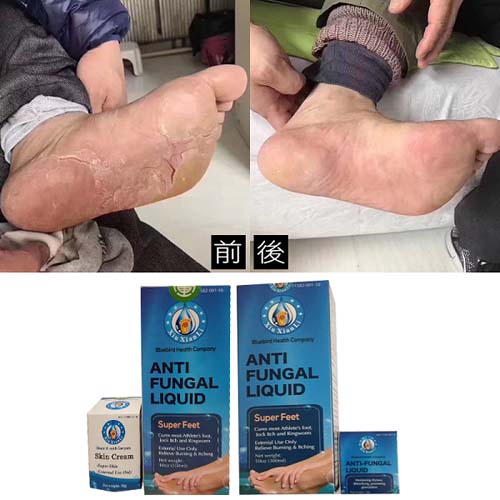 灰指甲‧手足癬 图片 7