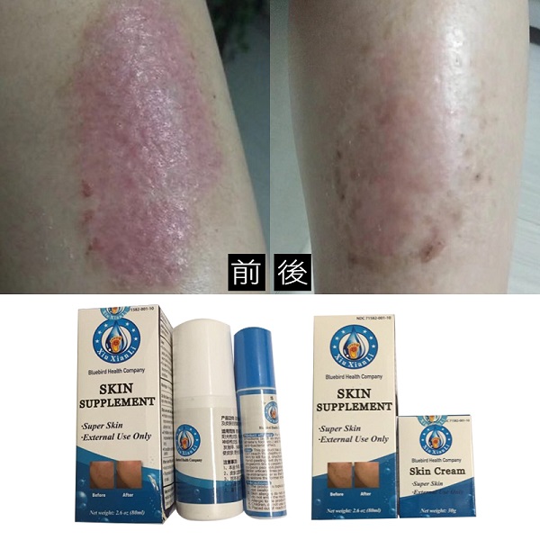 灰指甲‧手足癬 图片 4